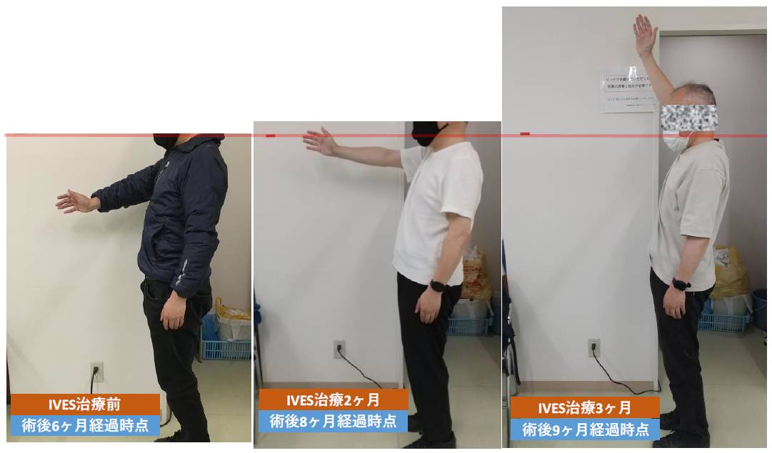IVES治療症例
